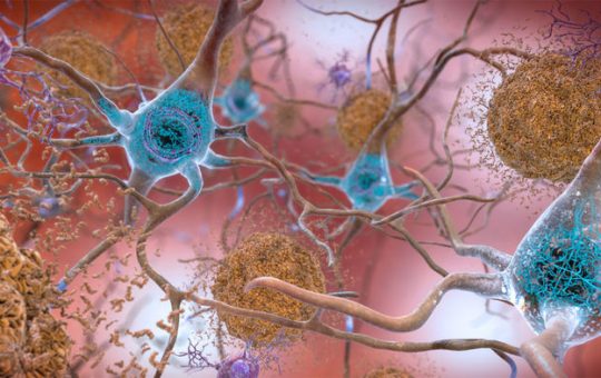 Uma nova droga de anticorpo removeu as placas de proteína (à direita) que se formam em torno dos neurônios na doença de Alzheimer. INSTITUTO NACIONAL DO ENVELHECIMENTO / INSTITUTOS NACIONAIS DE SAÚDE